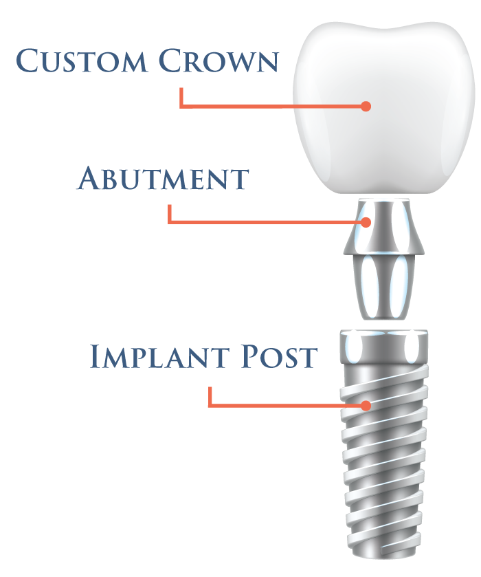 Dental Implant Anatomy