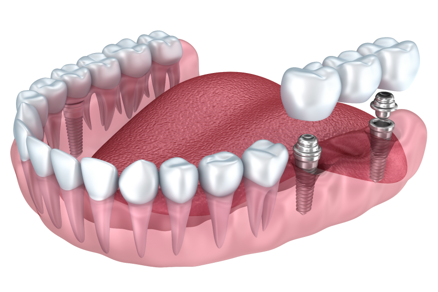 Dental implant Supported Bridges