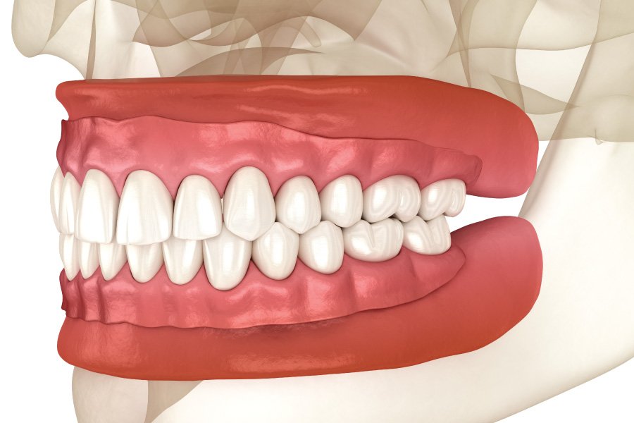 Full Dentures