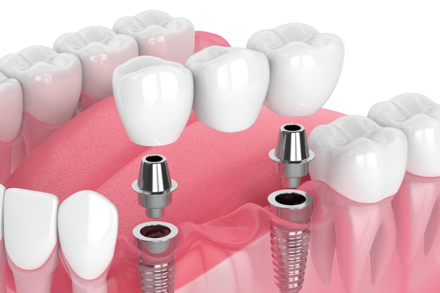 Implant-Supported Bridges