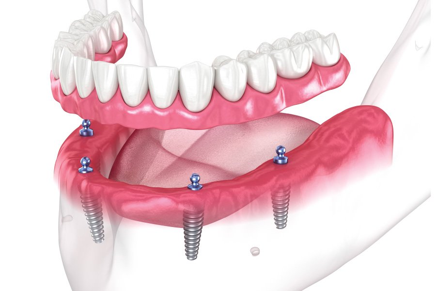 Implant-Supported Dentures