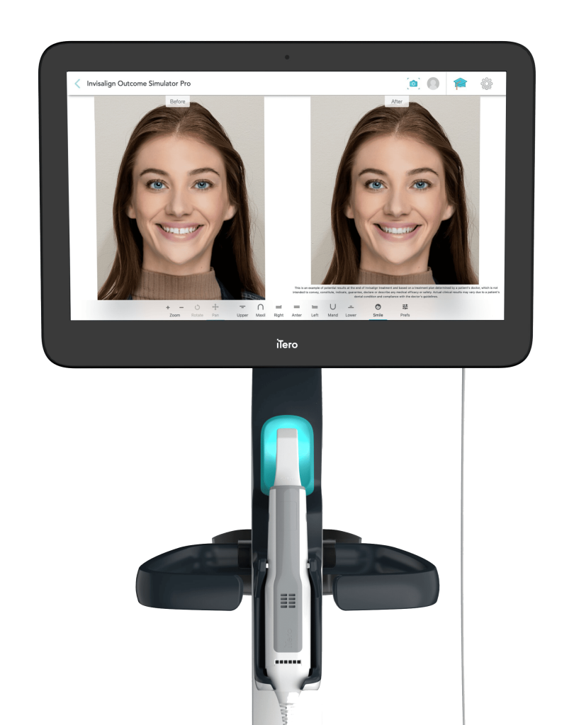 iTero Digital Scanner
