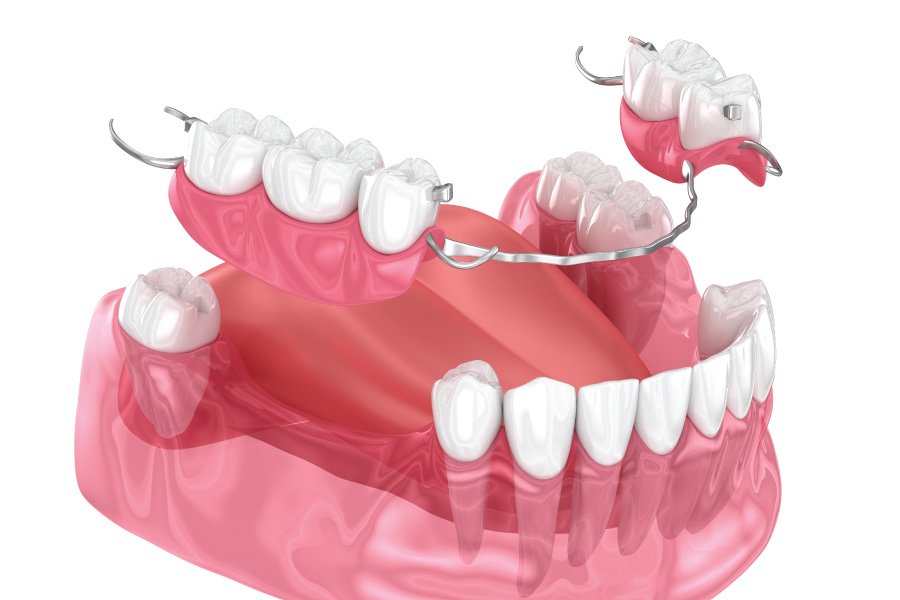 Partial Dentures