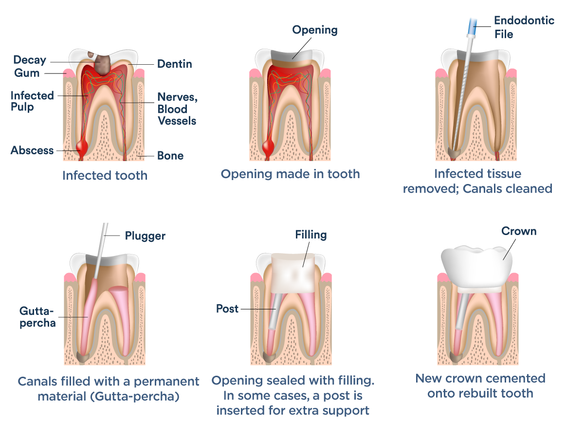 Root Canals