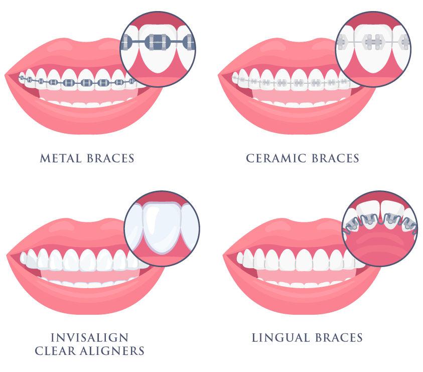 Types of Braces