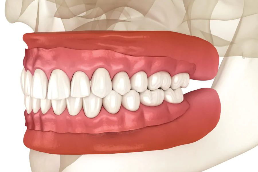 Full Dentures