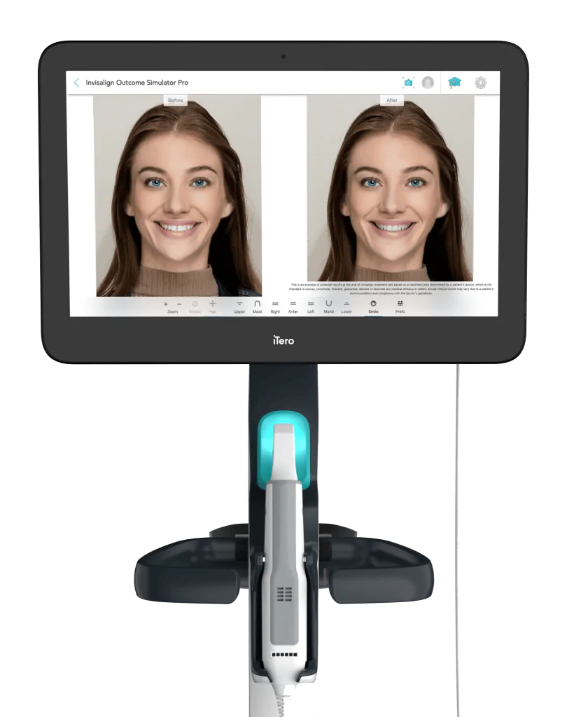 iTero Digital Scanner
