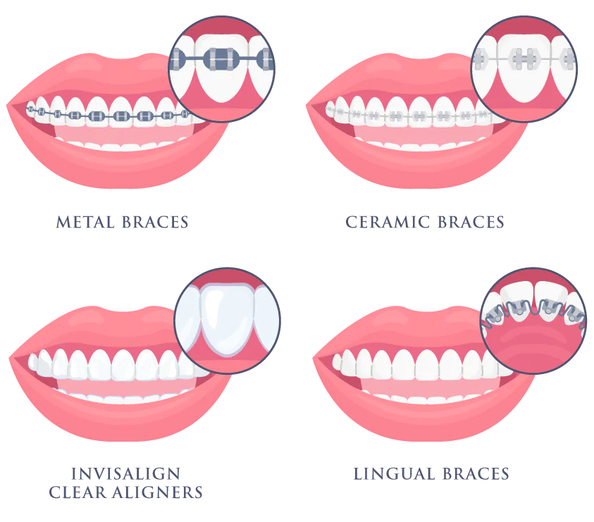 Types of Braces